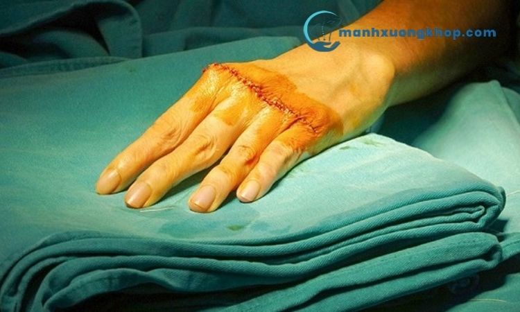 Các phương pháp điều trị cứng khớp ngón tay 1
