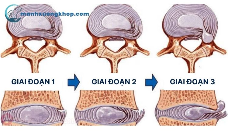 Triệu chứng thoát vị đĩa đệm lưng theo từng giai đoạn 1