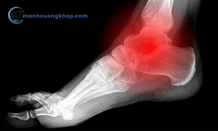 Chẩn đoán viêm khớp cổ chân như thế nào? 1