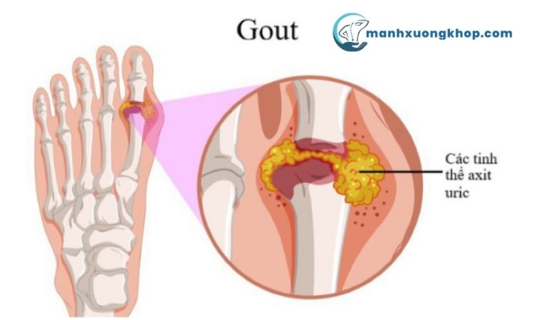 Bệnh Gout 1
